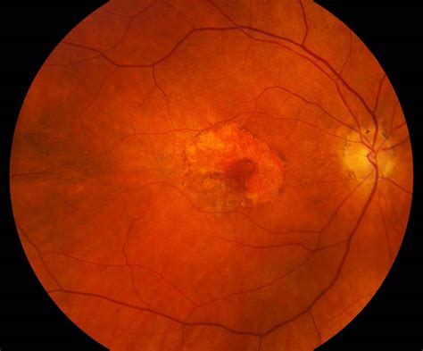 Central vision is what we see in the middle of our field of vision, rather than what is off to the sides (peripheral vision). . Juvenile macular degeneration columbus